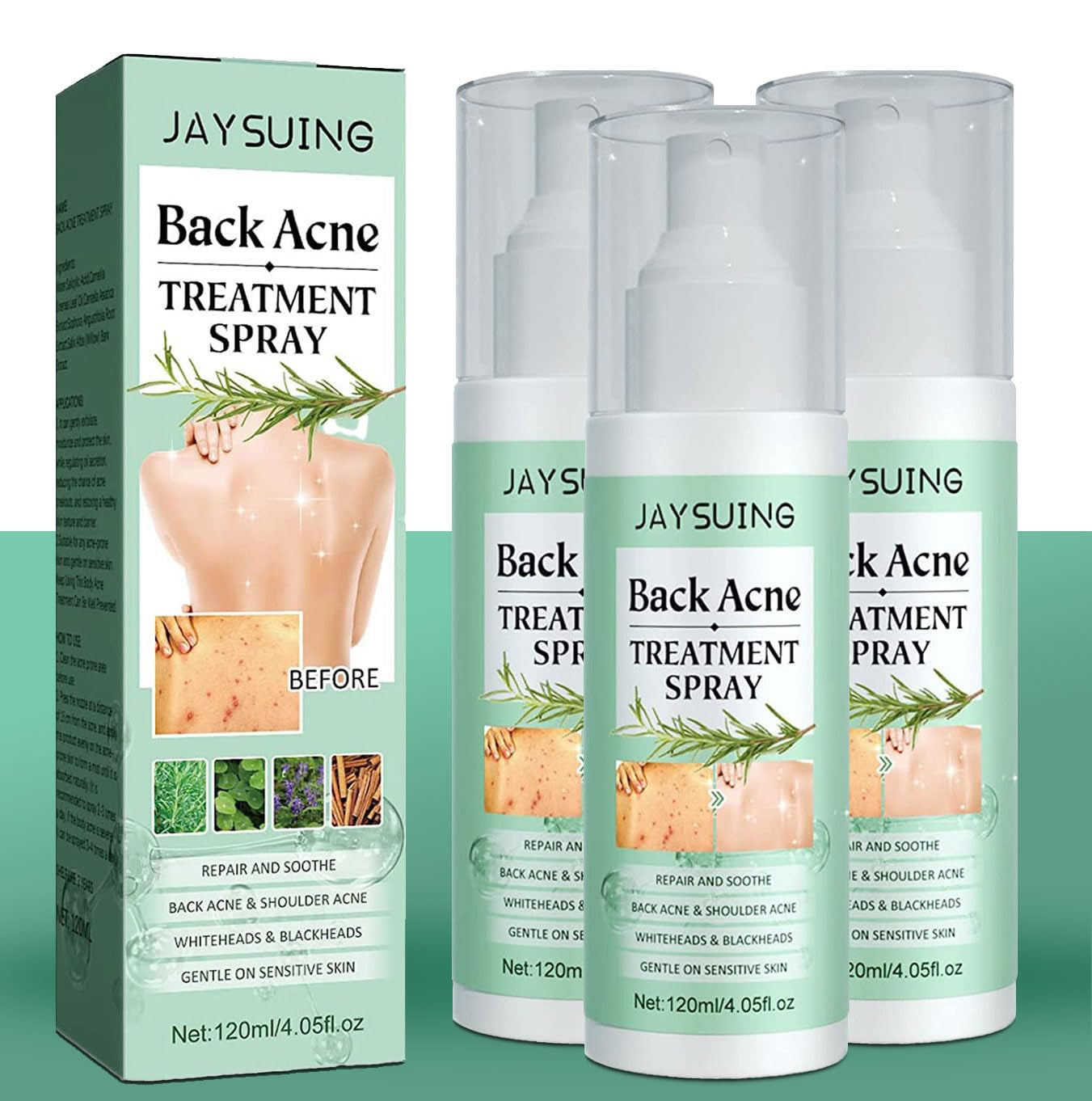 3 Pack Back Acne Treatment, Back Acne Spray, 2% Salicylic Acid Spray, Body Acne Treatment with Herbal Formula, Body Acne Spray, Tea Tree Oil Spray, Acne Treatment for Teens, Back Acne Solution