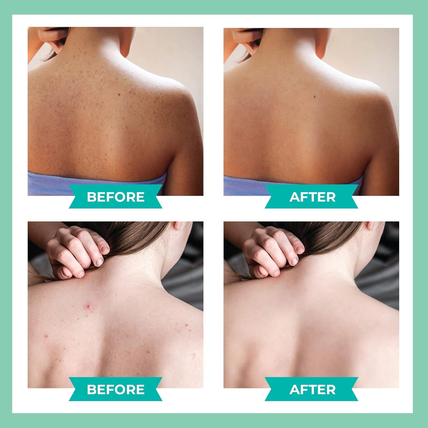 3 Pack Back Acne Treatment, Back Acne Spray, 2% Salicylic Acid Spray, Body Acne Treatment with Herbal Formula, Body Acne Spray, Tea Tree Oil Spray, Acne Treatment for Teens, Back Acne Solution