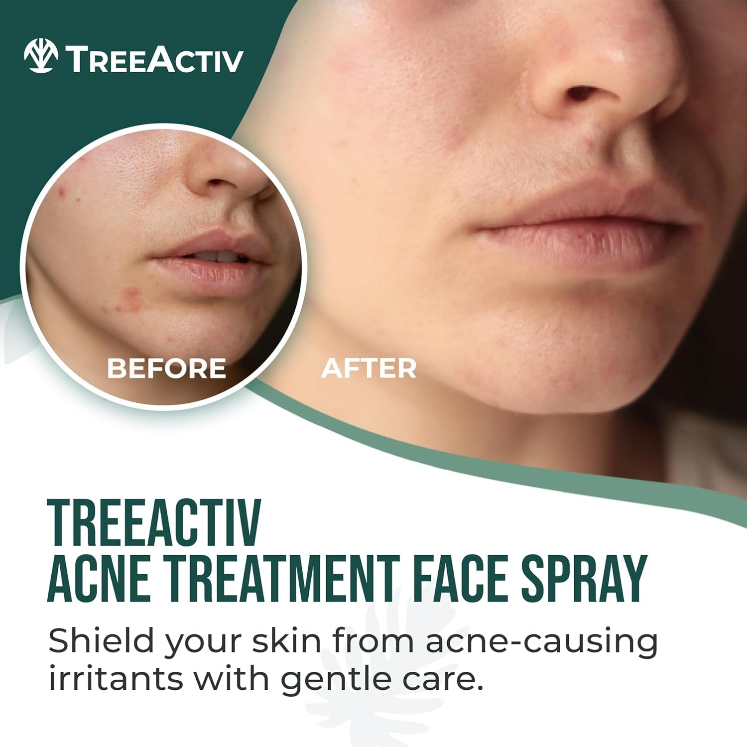 Acne Treatment Face Spray, 4 Fl Oz Facial Spray with Witch Hazel, Salicylic Acid for Acne Prone and Oily Skin, for Hormonal, Severe Cystic Acne, Skin Clearing Toner, 1000 Sprays